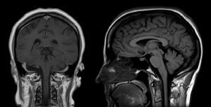 CT Brain scan image on Magnetic Resonance Imaging (MRI)