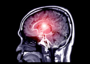 Fusion image of MRI and MRA Brain or Magnetic resonance angiography ( MRA ) of cerebral artery in the brain Sagittal view for evaluate them stenosis and stroke disease.